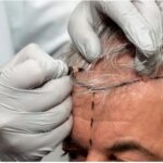 hair transplant for men