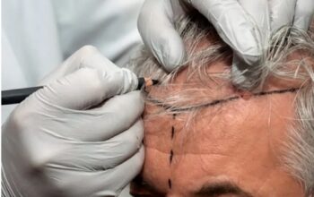 hair transplant for men